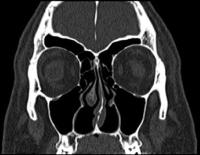 Nenäontelo CT-kuvassa